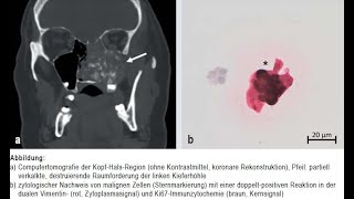 High grade Osteosarkom der Kieferhöhle [upl. by Shapiro]