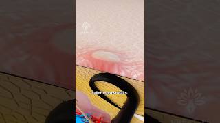 Why Ingrown Hairs Form😮 ingrownhair shorts viralvideo  Creativelearning3d [upl. by Lledra]