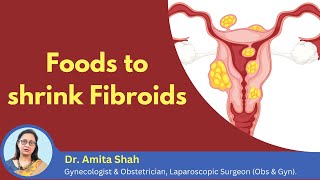 How to shrink the growth of fibroids  Fibroid shrinking foods  Dr Amita Shah [upl. by Ennaimaj]