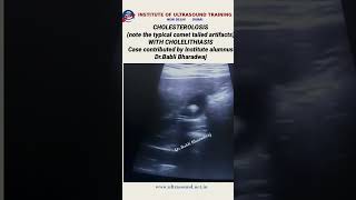 Cholesterolosis with cholelithiasis ultrasound ultrasoundlife pocus [upl. by Hump629]