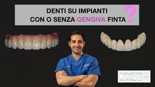 Denti su impianti con o senza gengiva finta [upl. by Eiruam156]