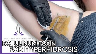 Botulinum Toxin For Hyperhidrosis  Rediscovered Skin Clinic [upl. by Lamek]