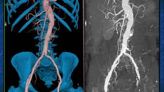 CTA of the Renal Arteries What You Need to Know  Part 1 [upl. by Antonina]