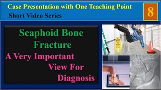 Scaphoid Bone Fracture Case Presentation with One Teaching Point [upl. by Hanyaz796]