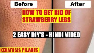 How to Get Rid of Strawberry Legs Fast  Hindi Easy DIY  Wamika Beauty [upl. by Oiram]