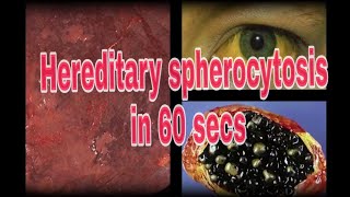 Hereditary Spherocytosis  A 60 sec Pathology lecture [upl. by Suk]