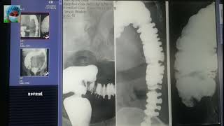 Radiology cases Esophagography Gastrography Barium enema Irrigography online x ray library part 53 [upl. by Euqinomahs]