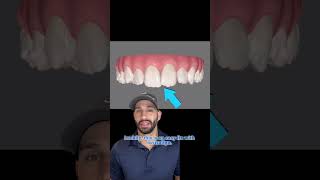 Invisalign treatment to straighten overlapped and crooked front teeth [upl. by Junno]