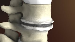 Degenerative Disc Disease Spondylosis explained by Spine Surgeon Dr Jessica Shellock Plano TX [upl. by Asilet]