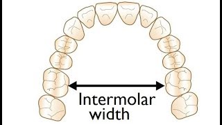 Measurement of Intermolar Width on a Model for Orthodontic Treatment by Dr Mike Mew [upl. by Goer802]