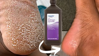 TRY HYDROGEN PEROXIDE ON YOUR FEET AND SEE WHAT HAPPENS Shocking [upl. by Enomahs]