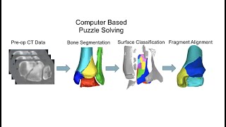 Pilon Fractures Dr Jamal al Asiri FRCSC [upl. by Uchida]