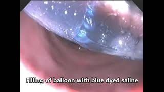 Intragastric balloon insertion [upl. by Aicirtam]