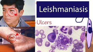 Leishmaniasis  Symptoms and Treatment of Leishmaniasis Explained under 3 minutes [upl. by Waylen55]