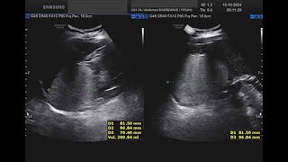 angiomiolipoma surrenalico destro [upl. by Nwhas]