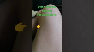 muscle fasciculations form Lyme lymeawareness [upl. by Anauqes]