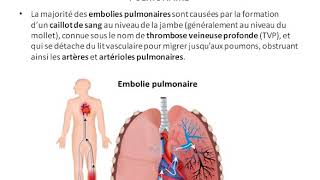 L embolie pulmonaire [upl. by Eppes]