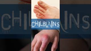 How to avoid Chilblains shorts [upl. by Croix]