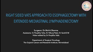 VATS Esophagectomy with Extended Mediastinal Lymphadenectomy [upl. by Arlo]