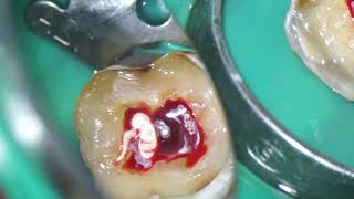 비가역치수염 3단계  Symptomatic irreversible pulpitis with severe pain [upl. by Navaj]