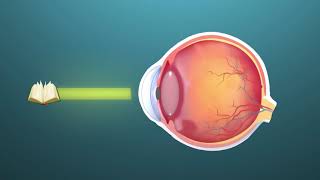 Presbyopia ophthalmology  Animation [upl. by Bernita]