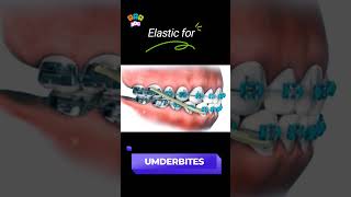 Underbite braces transformation bracesorthodontist dentist shortsfeed [upl. by Anek]