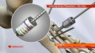 CLAW™ II Polyaxial Compression Plating Animation [upl. by Kcirdneked]