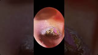 Earwax Removal Part 75 [upl. by Seaver]