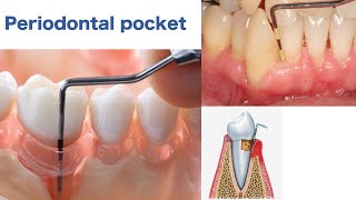 Periodontal Pocket [upl. by Ihab833]