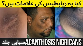 Acanthosis Nigricans Causes  Symptoms Treatment [upl. by Miru77]