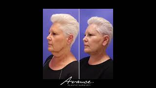 67YearOld Patient Mini FaceNecklift Results  Avance Plastic Surgery Institute Dr Erez Dayan [upl. by Ingar239]