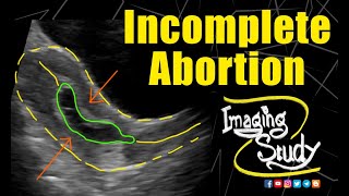 Incomplete Abortion  Ultrasound  Case 180 [upl. by Eustatius]