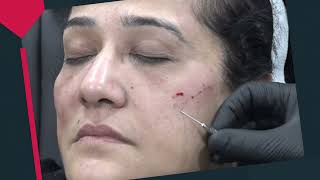 Full Facelift With Fillers  Facial Aesthetics Training  Dr Akshay Bagade  facialist [upl. by Enomas]