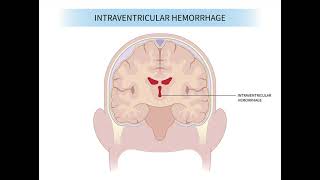 Intraventricular Haemorrhage mrcpch Recall Communication [upl. by Sihtnyc40]