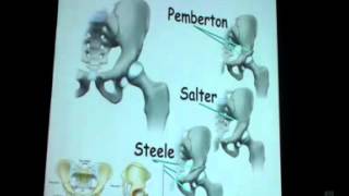 Osteotomies Around Hip Prof Dr Khaled Emara [upl. by Esor]