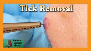 Dead Tick Removal  Auburn Medical Group [upl. by Aener]