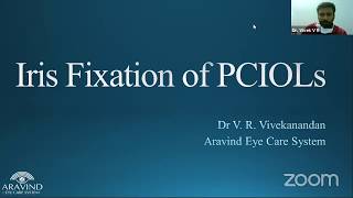 Iris fixated iol technique  Secondary IOL Techniques  EYE TODAY talk [upl. by Ehtyde]