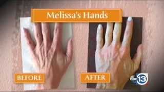 How to Repair Aging Hands and Make Your Hands Look Younger [upl. by Hazlip]