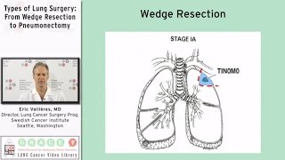 Types of Lung Surgery From Wedge Resection to Pneumonectomy [upl. by Xonnel284]