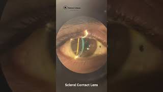 Contact Lens Fitting in Keratoconus  RGP Lenses  Rose K2 Lenses  Scleral Lenses  Hyderabad [upl. by Herrah781]