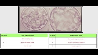 IVF Embryo Grading  AB and BB [upl. by Nnaaras]