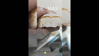 Dental video Emax [upl. by Samanthia]