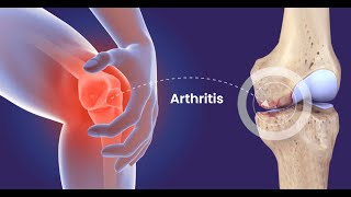 reasons for arthrities [upl. by Adnohsad768]