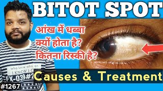 आंख में ये धब्बा कैसा  Bitot Spot Cause amp Treatment In Hindi [upl. by Eoz32]