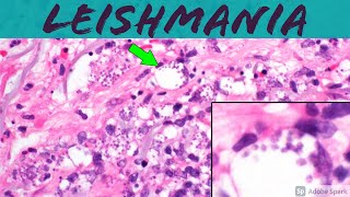 Leishmaniasis Leishmania Infection 5Minute Pathology Pearls ‪Dermatology Dermatopathology [upl. by Berkin502]