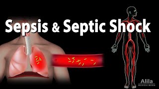 Sepsis and Septic Shock Animation [upl. by Tirb486]