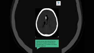 Neuroradiology Quiz case level 1  Headache CT  Incidental brain abnormalities [upl. by Staten]