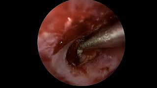 Ear drum repair tympanoplasty with lateral graft [upl. by Hanahsuar]