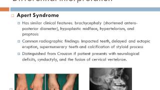 Crouzon Syndrome [upl. by Leahcym115]