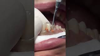 Composite restoration dentist satisfying [upl. by Nefets]